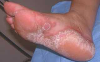Все что нужно знать о грибке на ступнях