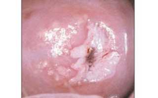 Белые пятна на шейке матки: причины возникновения, диагностика и лечение