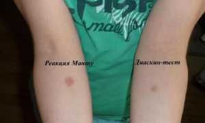 Прививка Диаскинтест: официальная инструкция, чем отличается от Манту, отзывы