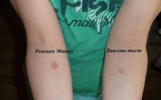 Прививка Диаскинтест: официальная инструкция, чем отличается от Манту, отзывы