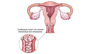 Поражение кандидозом половых органов человека