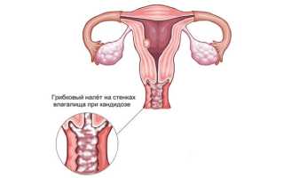 Поражение кандидозом половых органов человека