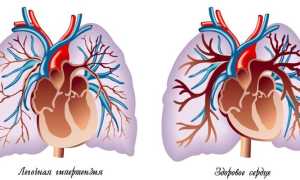 Легочная гипертензия – что это такое: степени и лечение заболевания