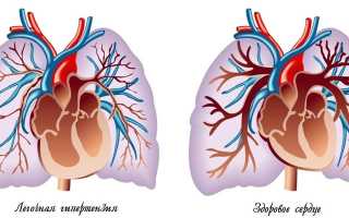 Легочная гипертензия – что это такое: степени и лечение заболевания