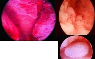 Почему появляется гравидарный эндометрий?