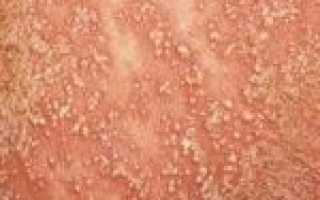 Причины возникновения псориаза и его диагностика