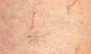 Есть ли между псориазом и больной печенью взаимосвязь?