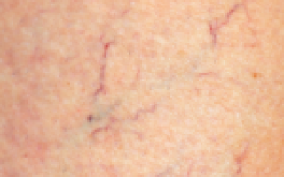 Есть ли между псориазом и больной печенью взаимосвязь?