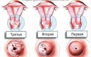 Совместимы ли беременность и дисплазия шейки матки?