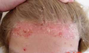 Является ли психосоматика одной из причин псориаза?