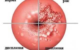 Дискариоз шейки матки: рак или предраковое состояние?