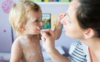 Мазь при ветрянке у детей и взрослых