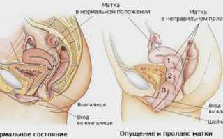 Как вылечить опущение матки в домашних условиях и стоит ли это делать?