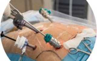 Удаление почки: операция и послеоперационный период