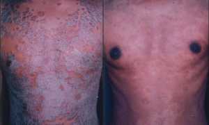 Что такое ПУВА терапия и как она может помочь при псориазе?