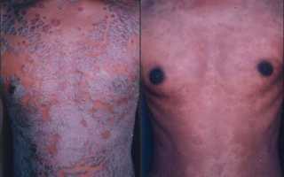 Что такое ПУВА терапия и как она может помочь при псориазе?