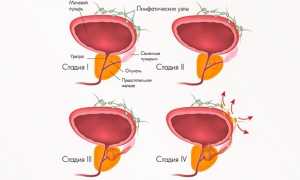 Симптомы бактериального простатита — признаки острого и хронического