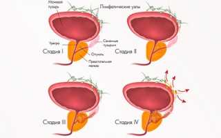 Симптомы бактериального простатита — признаки острого и хронического