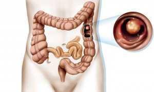 Кал с кровью — причины возникновения у мужчин и женщин