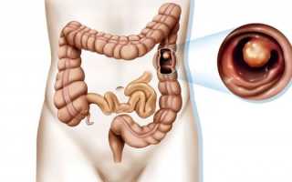 Кал с кровью — причины возникновения у мужчин и женщин