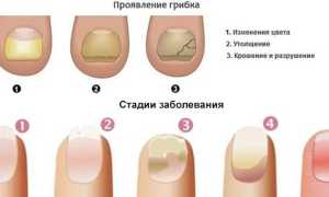 Грибок ногтей на руках — стадии и как вылечить в домашних условиях