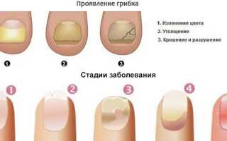 Грибок ногтей на руках — стадии и как вылечить в домашних условиях