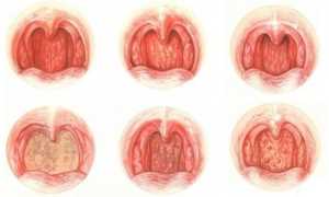 Чем лечить горло при беременности