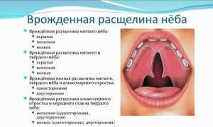 Волчья пасть у ребенка — причины и операция по коррекции
