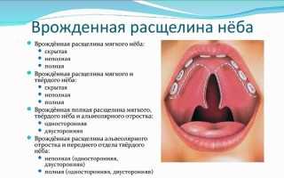 Волчья пасть у ребенка — причины и операция по коррекции
