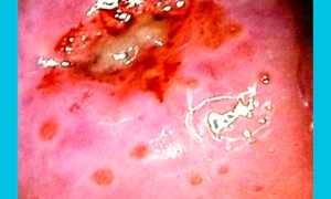 Когда можно забеременеть после прижигания эрозии