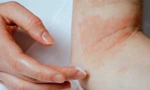 Самые распространенные грибковые заболевания кожи и их лечение