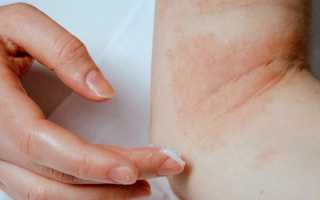 Самые распространенные грибковые заболевания кожи и их лечение