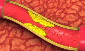 Антисклеротические препараты нового поколения для лечения атеросклероза