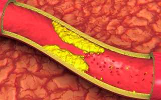 Антисклеротические препараты нового поколения для лечения атеросклероза