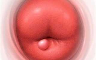 Парацервикальные кисты шейки матки: стоит ли от них избавляться?