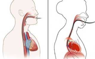 Проявление политопной и полиморфной желудочковой экстрасистолии: как лечить
