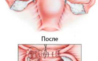 Удаление матки с придатками (гистеросальпингоовариэктомия)