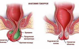 Геморрой при беременности