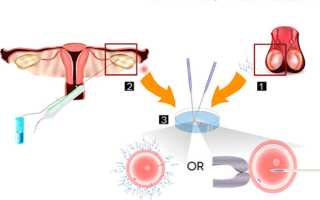 Двойня после ЭКО: типы двойни и как вынашивать