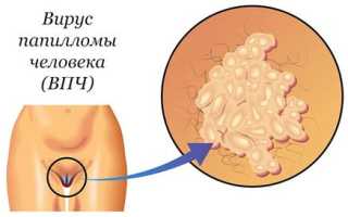 Как развивается ВПЧ при беременности?