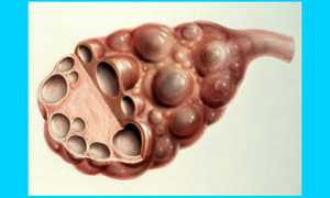 Беременность и поликистоз яичников: симптомы и лечение