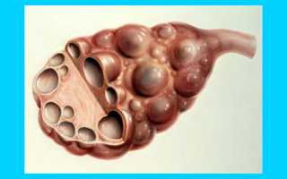 Беременность и поликистоз яичников: симптомы и лечение