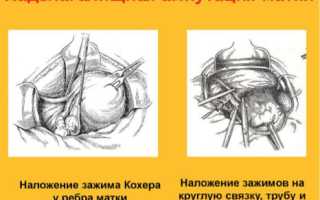 Надвлагалищная ампутация матки: положительные и отрицательные стороны