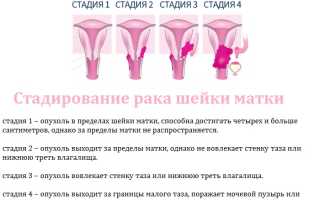 Как меняется жизнь после рака шейки матки?