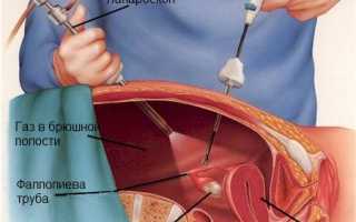 Когда проводится милкинг при внематочной беременности?
