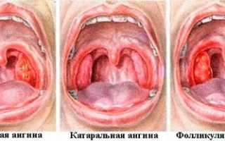 Опасность ангины при беременности и особенности ее терапии