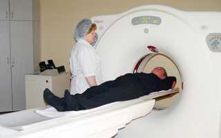 Менингиома головного мозга: лечение без операции