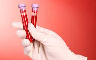 Мононуклеоз у детей — что это за заболевание