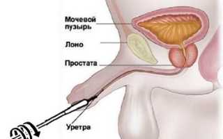 Что такое мазок уретры урология