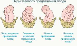 Тазовое предлежание плода, как проходят роды?